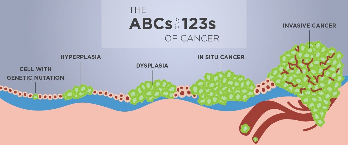 The Abcs And 123s Of Cancer Stages 7286