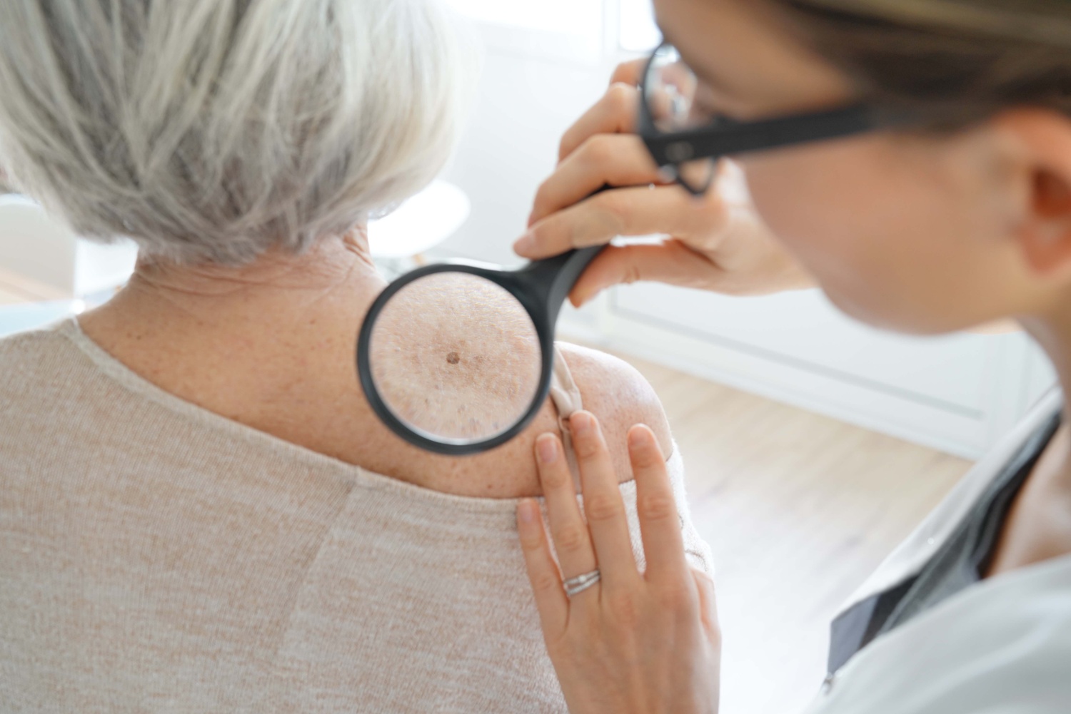 Insights on Warts, Moles, and Skin Tags from a Dermatologist