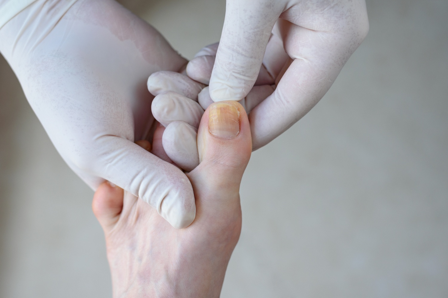 What You Need to Know About Treating Nail Fungus with a Dermatologist